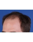 Before Hair Transplant&nbsp;Front